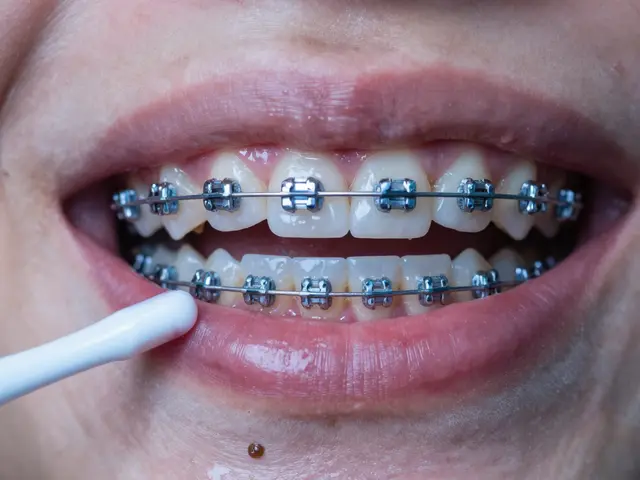 Zničené zuby po rovnátkách: Co dělat a jak se jim vyhnout