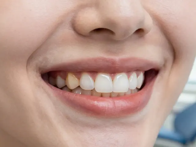 Fazety na zuby: Jaké jsou možnosti údržby a jak jim prodloužit životnost?