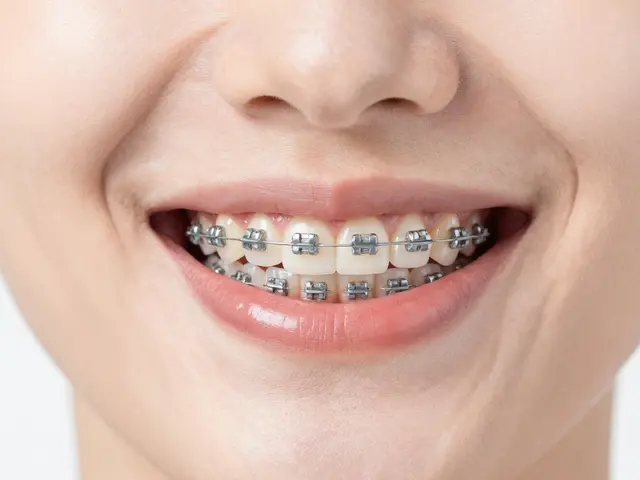 Jak dlouho trvá rovnatka? Aktuální průvodce dobou léčby a tipy pro keramické rovnátka